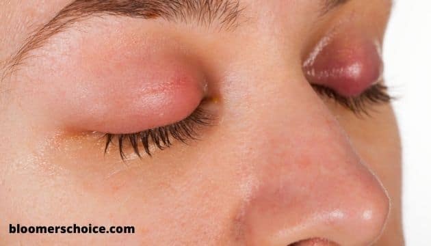 Can You Wear Makeup With A Chalazion