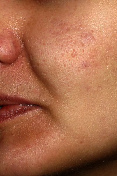 enlarged pores on a woman face