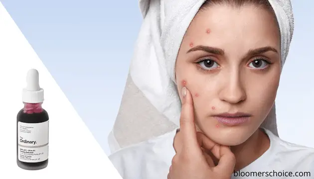 peeling solution for acne
